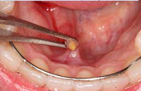 اضرار حصوات الغدة اللعابية المرسال