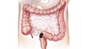 Ich weiß echt nicht mehr weiter. Darmkrebs Basis Infos Fur Patienten Dkg