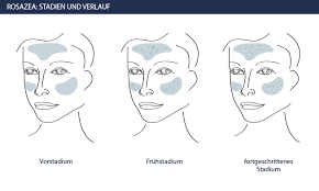 Rhinophym ist eine erkrankung, die die entwicklung einer großen, bauchigen nase verursacht, die mit einer granulomatösen infiltration verbunden ist, üblicherweise aufgrund einer unbehandelten rosacea. Couperose Rosazea Symptome Behandlung Ursachen Info Medizin
