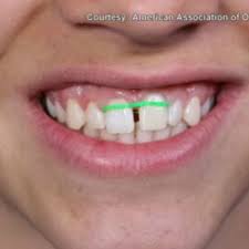Gaps in between teeth usually tend to look ugly, n people tend to rush to the orthodontist most often. On Your Side Orthodontists Call Diy Braces A Dangerous Trend Wgme