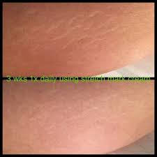 Stretch Mark Cream