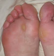 However, in certain cases the spots under the feet could. Callus Wikipedia