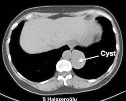 Akciger Kistleri Ve Tedavisi Gogus Cerrahisi Prof Dr Semih Halezeroglu