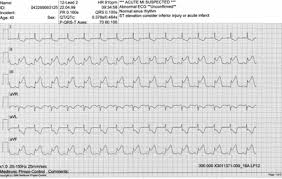 Sie bezieht sich auf die veränderungen im ekg, der. Universitatsklinikum Regensburg Herzinfarkt