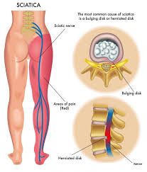 The eu estimated that more than 100,000 russian soldiers had amassed near the border as well as in crimea. Pinched Nerve Lower Back Help Concentric Rehabilitation Centre