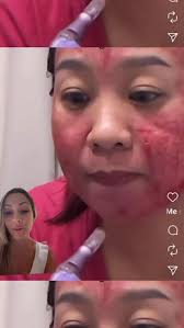 Peligro ⚠️ no hagas procedimientos si no tienes la capacitación solo  dañarás tu piel , #estetica #cuidadodelapiel #esteticista #skincare #facial  #esthetician #masterclass #faciales #esteticafacial ...