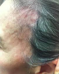 Hirsutism is excess hair most often noticeable around the mouth and chin. Clinical Recognition And Management Of Alopecia In Women Of Color Sciencedirect