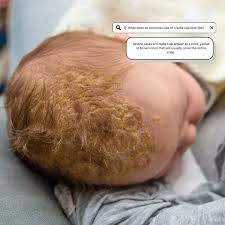 Image result for Cradle Cap