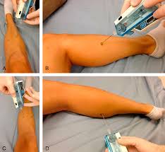 Image result for Compartment Syndrome