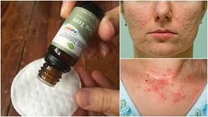 Tea tree oil has shown effectiveness in inhibiting the growth of candida, a yeast which, upon overgrowth can cause infection such as candidiasis, typically found in the mouth, intestinal tract and genitals. 10 Reasons To Put Tea Tree Oil On Your Skin Beat Acne Eczema More