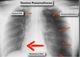 Image result for Open Pneumothorax