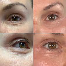The plasma pen is an fda approved, ce approved device used to perform fibroblast therapy, a technique used to stimulate production of collagen in the skin. Plasma Pen In Scottsdale Chandler Plasma Pen Treatment