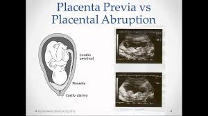 Interestingly, a recent study found significantly fewer trophoblasts in women who had been diagnosed with ectopic pregnancy (an embryo attached outside the uterus) or blighted ovum. Blighted Ovum And Missed Miscarriage Wehavekids