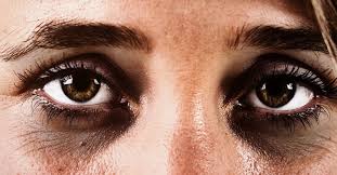 dark circles under the eyes causes and