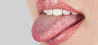 Check spelling or type a new query. Cara Sembuhkan Sariawan Di Lidah Gunakan Obat Antijamur Lamanqu Id