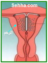 كيف تركيب اللولب اجمل جديد