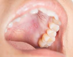 Bump on roof of mouth that randomly appeared with a little pain. Bump On The Roof Of The Mouth 12 Causes