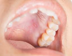 There are a number of reasons which cause bumps in your mouth. Bump On The Roof Of The Mouth 12 Causes