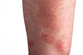 Is Stevens Johnson Syndrome Contagious Top Class Actions