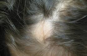 Most people only lose hair in small, round patches. Hair Loss Alopecia Areata In Children My Doctor Online