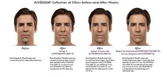All for you medspa > before / after. How Voluma Restores Cheek Volume Lifts Your Face