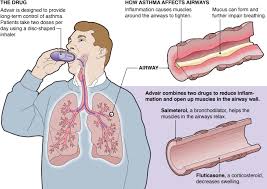Frying your nuts with radiation would be painful! Overuse Safety Questions Cloud Advair S Ascent To Asthma Blockbuster