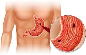 Chronische Gastritis Typ A B Und C Magenschleimhautentzundung Magen Und Darm Magen