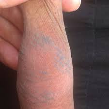 I grow hair on my penis shaft as a high dhtcel, its long black and thick, i have heard this is ideal for hair lasser removal, the question is: Are The Laser Epilation Burns On My Penis Permanent Photos