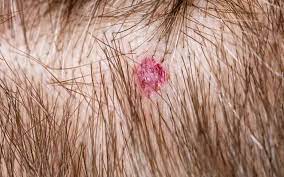 The rash may appear as pimples that come to white tips on the face, chest, back, arms, legs, buttocks, or head. Scalp Folliculitis Causes Symptoms Ayurvedic Remedies Vedix