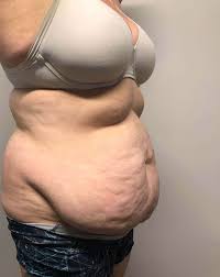 Before And After Liposuction After Weight Loss Surgery Mommy Makeover Tummy Tuck Photos