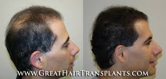 Dr Brett Bolton Hair Transplants Reviews by Ryan Excellent Hair Implant  Physician in Alabama Bibb Braehead