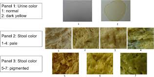 Image result for acholic stools human