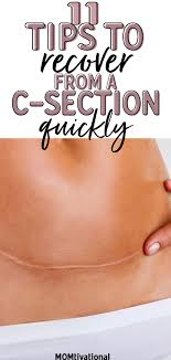 11 Tips To Recover From A C Section Quickly Painlessly C Section C Section Recovery Post Partum Workout
