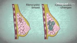 The pain is easily confused with sore muscles. How To Recognize Breast Cancer Symptoms Youtube