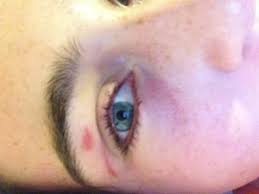 Rather than pulling out one stray hair at a time, nearly every hair is removed at once, a process that also strips the uppermost layer of skin cells and can be. Strip Wax Burn Help Beautylish
