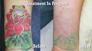 Its power and effect is smaller than the blue light. Laser Tattoo Removal Before After
