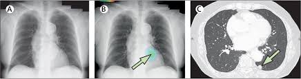 Image result for lung cancer xray