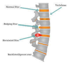 7 Herniated Disc Exercises For Lower Back Lumbar Area Herniated Disc Exercise Bulging Disc Herniated Disc