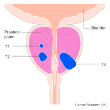 Image result for Prostate Cancer Staging
