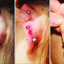 Local Infection With Granuloma After Helix Piercing Result One Week Download Scientific Diagram