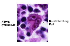 New Therapy Options Recently Approved For Hodgkin S Lymphoma U S Medicine