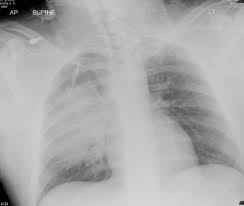 Image result for Pulmonary Contusion