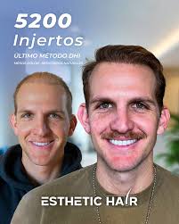 Turkish Hair Transplant in Cancun/Mexico