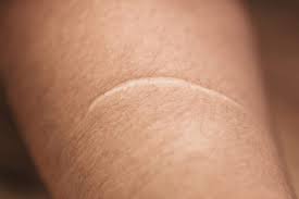 How to get rid of keloid scars. How To Get Rid Of Keloid Scars Getridofthings Com