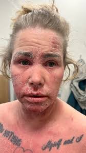 Rash update : AKA more of what they don't really tell you. So I have missed  two doses of Keytruda (immunotherapy drug) that's 6 weeks off. We will  still tack them on