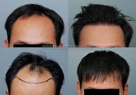 Types of hair transplantation procedures include fuss, fut (follicular unit transplantation) or the strip method, where a strip of tissue is removed from the scalp. Asian Male Hair Restoration Procedure Before And After Images With 4426 Grafts On Wednesday April 11 2012 Jerry E Cooley Md
