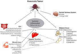 Image result for Cachexia in Cancer