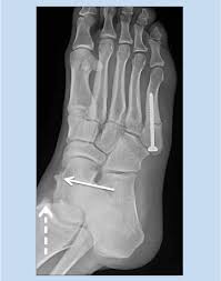 Wheel chairs are great for getting the mri didn't show any infection got to the bone but did show subcutaneous edema overlying the medial malleolus with cellulitis, nonspecific. Figure 10 From Medial Impingement Of The Ankle In Athletes Semantic Scholar