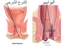 اعراض البواسير الخارجية ما هى اعراض مرض البواسير مشاعر اشتياق