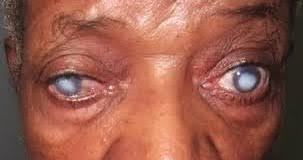Uch**i>> video ya ngono ya wanafunzi wa chuo wakif. Dalili Za Mtoto Wa Jicho Cataract Muungwana Blog